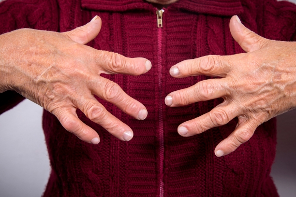 Rheumatoid Arthritis
