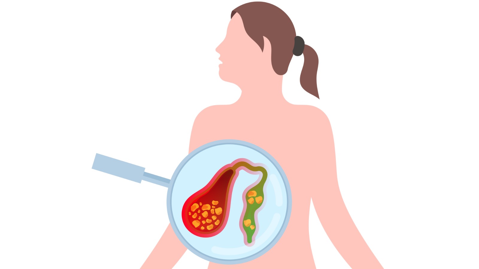 Learn about gallstones, their symptoms, causes, diagnosis, and treatment options. Discover prevention tips and effective management strategies for gallstone relief.