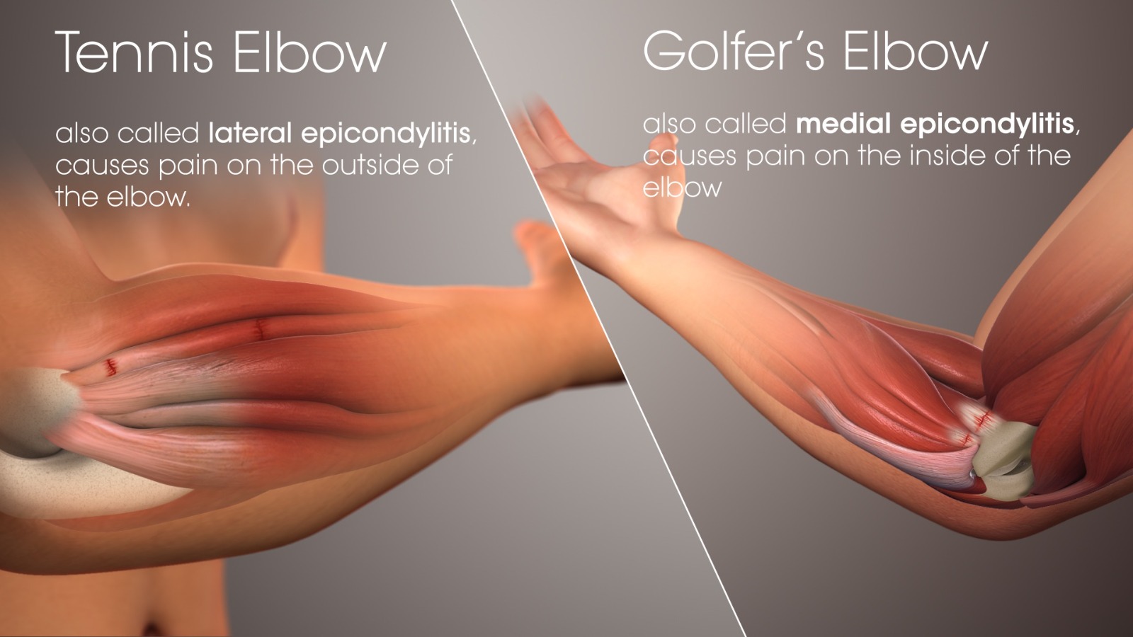 Tennis and Golfer's Elbow: Symptoms, Naturopathic and Conventional Management